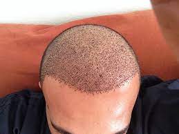 Saç Ekimi kapak görseli